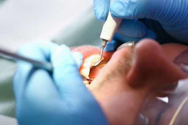 Best Emergency Wisdom Teeth Removal in New Bedford, MA